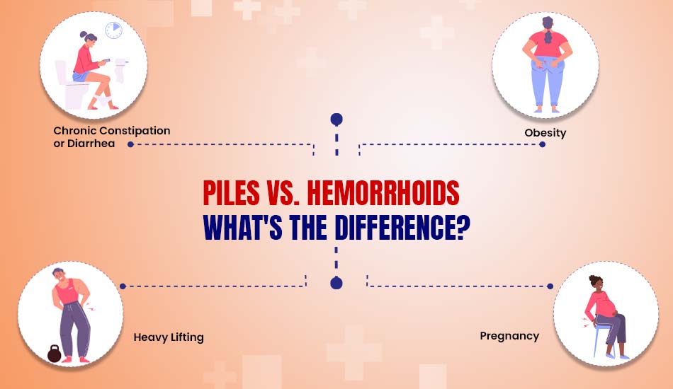 Piles vs. Hemorrhoids: What's the Difference?
